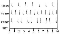 Some of my typical weird heart rhythms