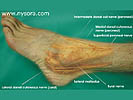sural nerve exposed
