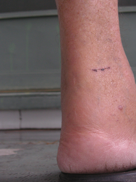 wound two weeks later