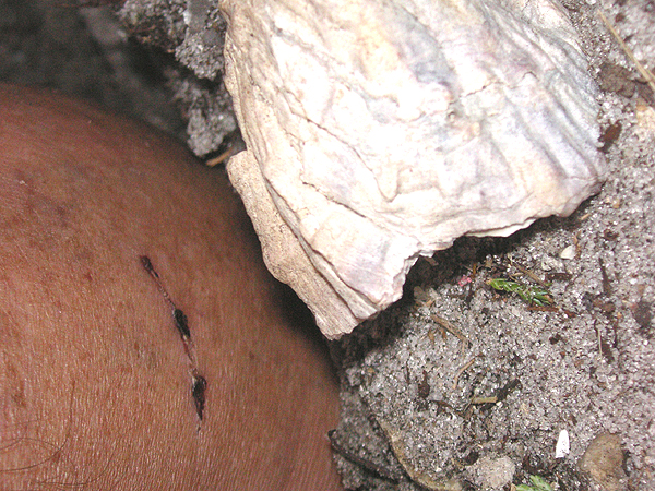 Injured foot placed next to likely position of object in situ