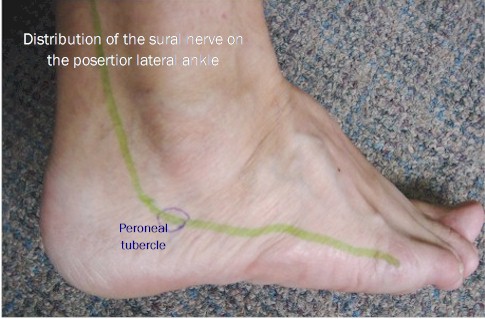 sural nerve in green